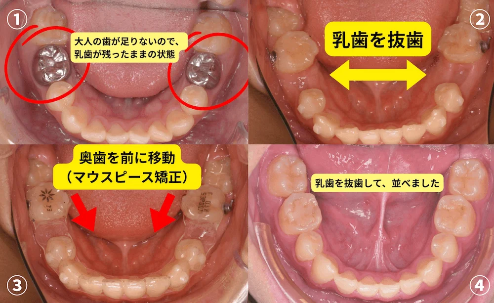 先天性欠損で乳歯が残った状態と、マウスピース矯正で奥歯を前に移動・乳歯を抜歯して並べた治療例