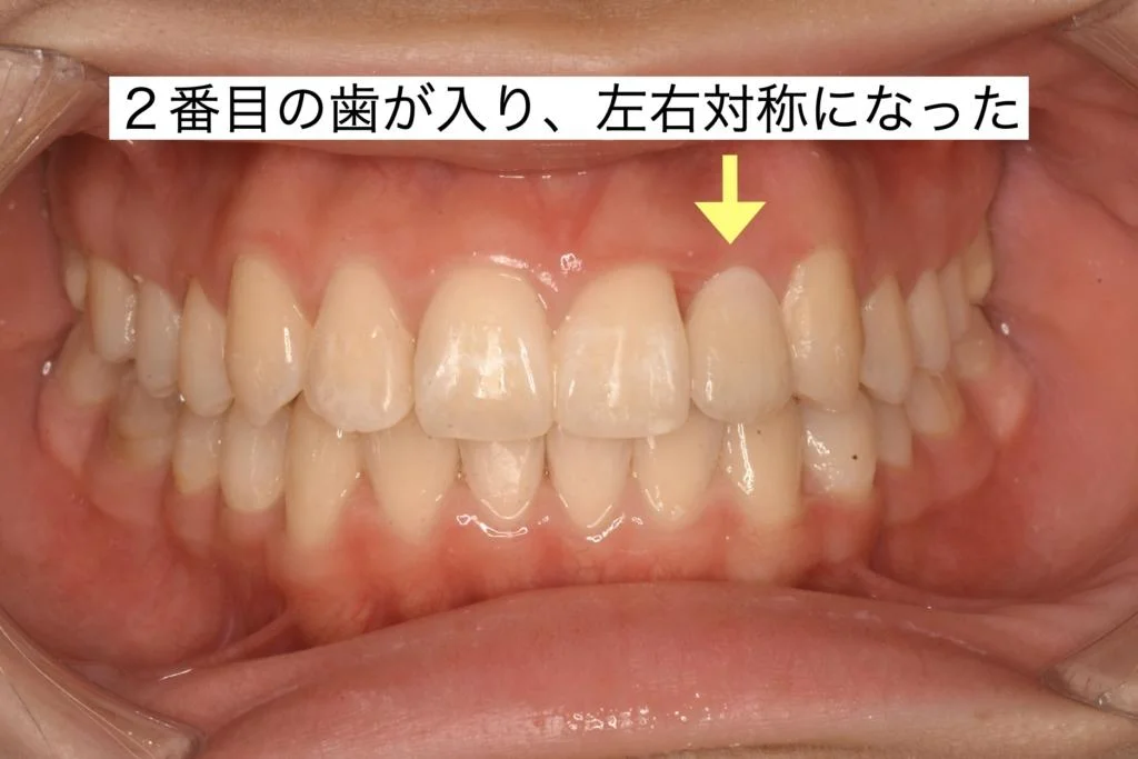 治療後 2番目の歯が入り左右対称になった