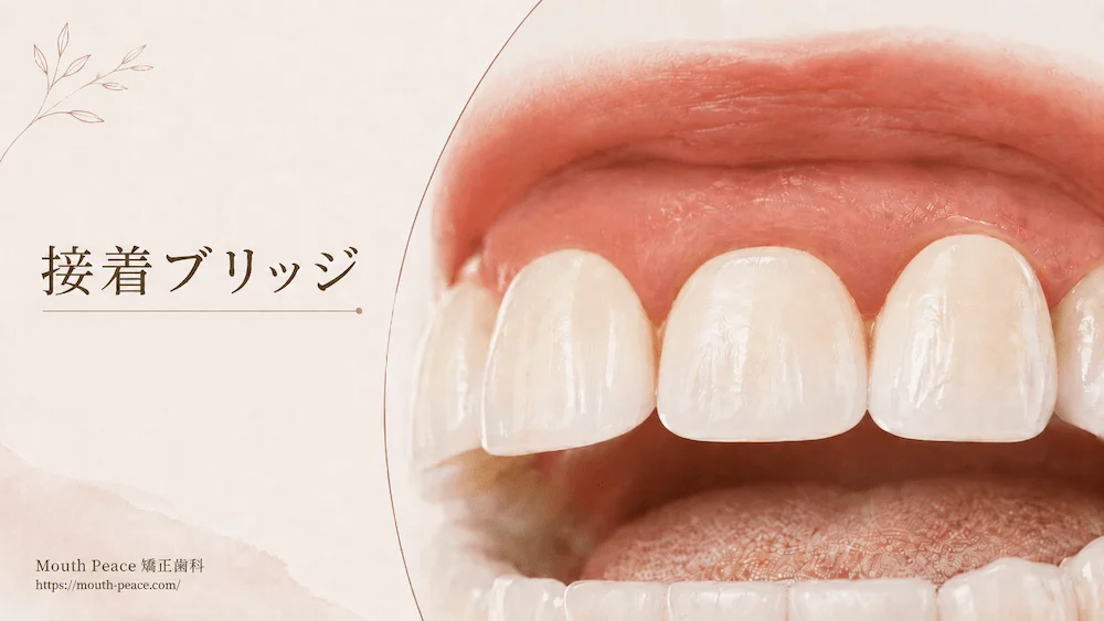接着ブリッジ