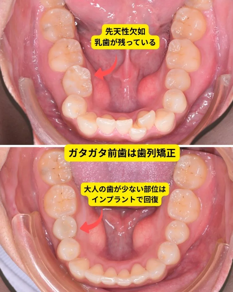 先天性欠損で奥歯に乳歯が残った状態と、インプラント併用＋歯列矯正で整えた治療例