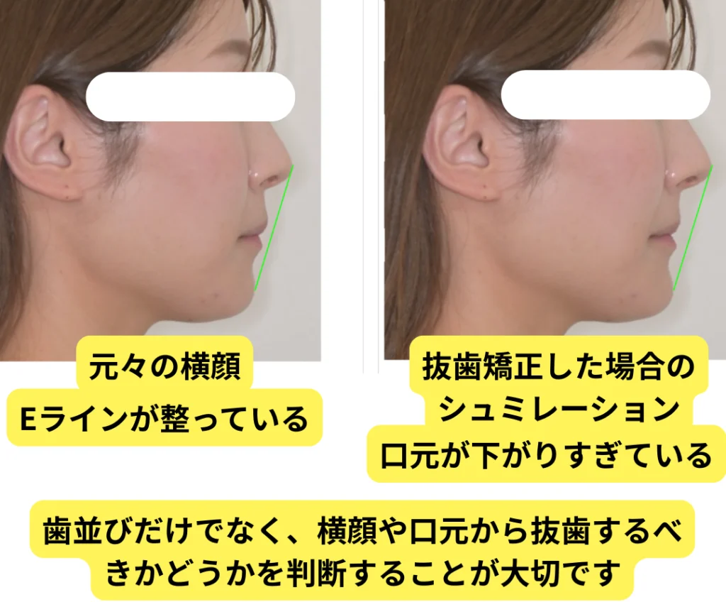 元々の横顔（Eラインが整っている）と抜歯矯正した場合のシミュレーション（口元が下がりすぎている）の比較