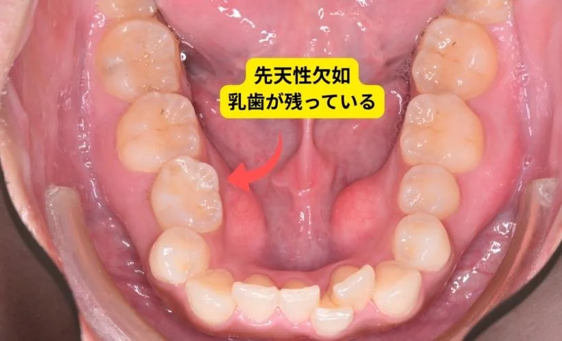 先天性欠如により乳歯が残っている状態