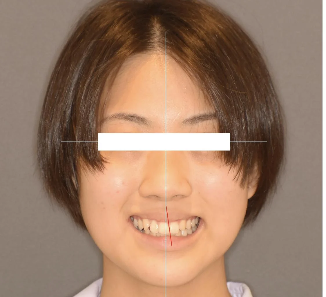 治療前 正中にズレのある状態