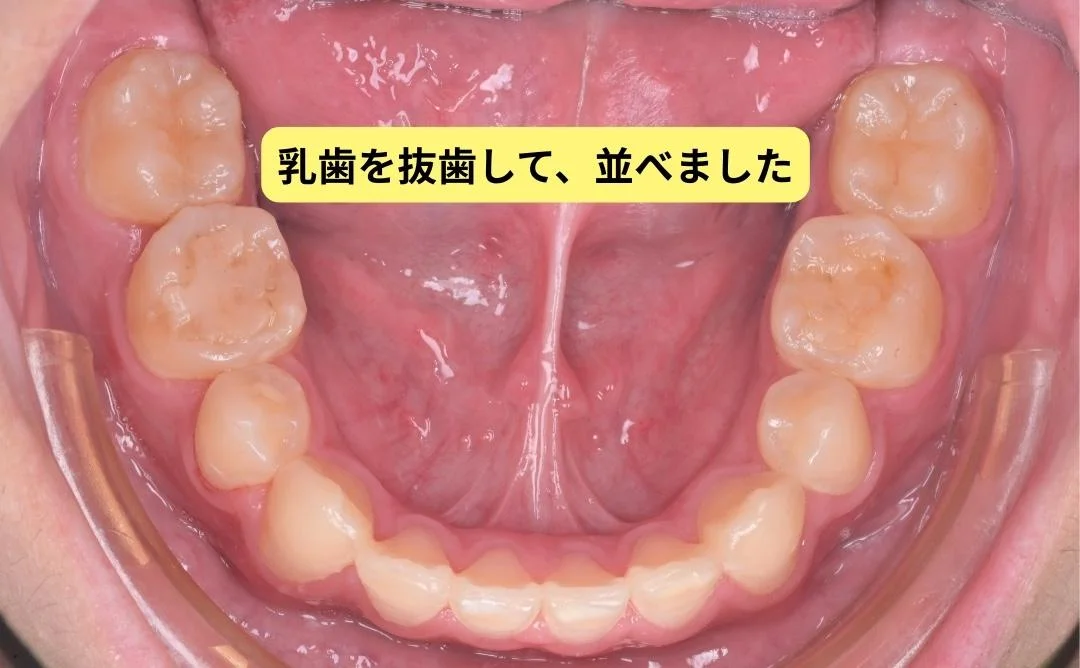 治療後 乳歯を抜歯して並べました