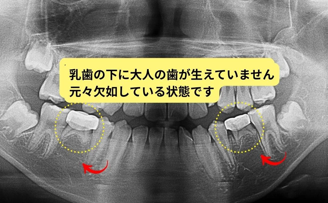 治療前のレントゲン 乳歯の下に永久歯が無く元々欠如している状態