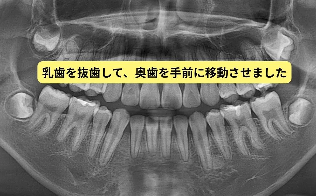 治療後のレントゲン 乳歯を抜歯して奥歯を手前に移動