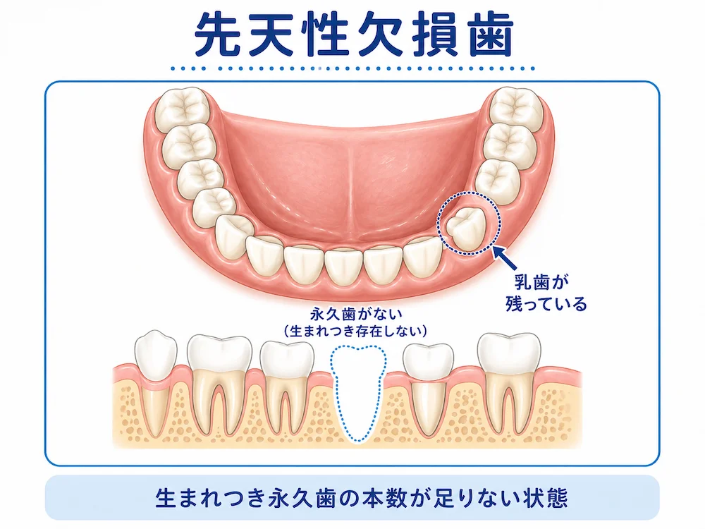 先天性欠損歯 生まれつき永久歯の本数が足りない状態