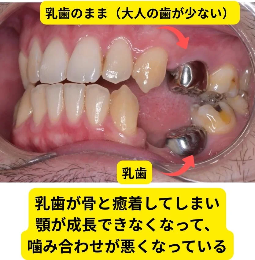 乳歯が骨と癒着して低位歯になり噛み合わせが悪くなっている状態