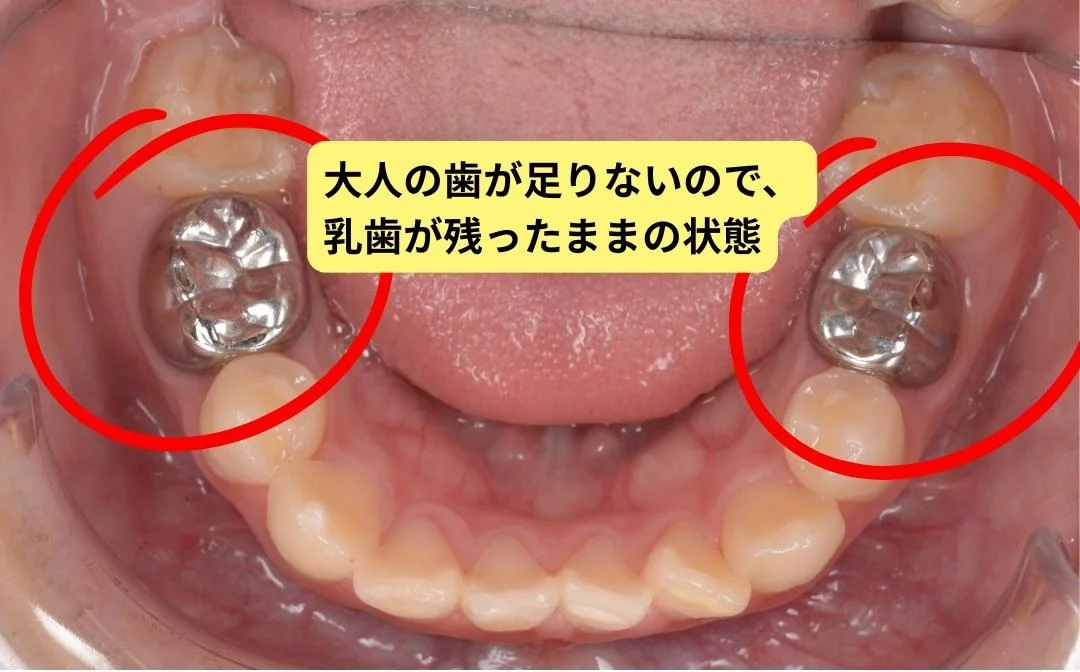 大人の歯が足りないので乳歯が残ったままの状態