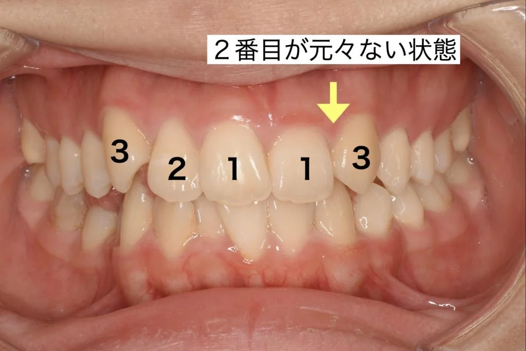 治療前 2番目が元々ない状態