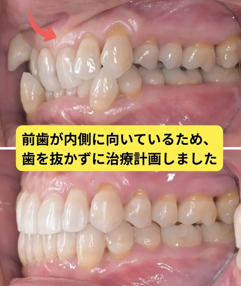 マウスピース矯正で八重歯は治療できる？