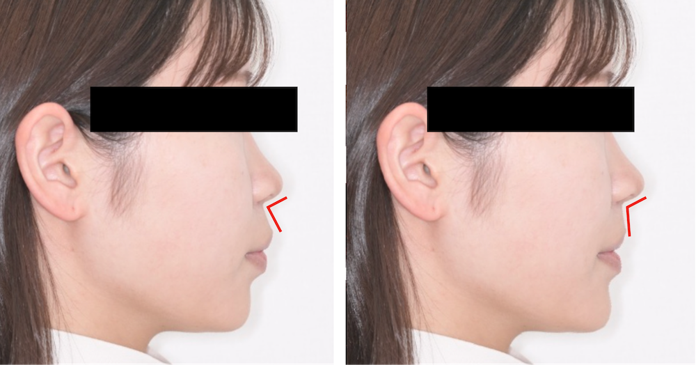 ③矯正後の顔貌の変化もシミュレーションできる