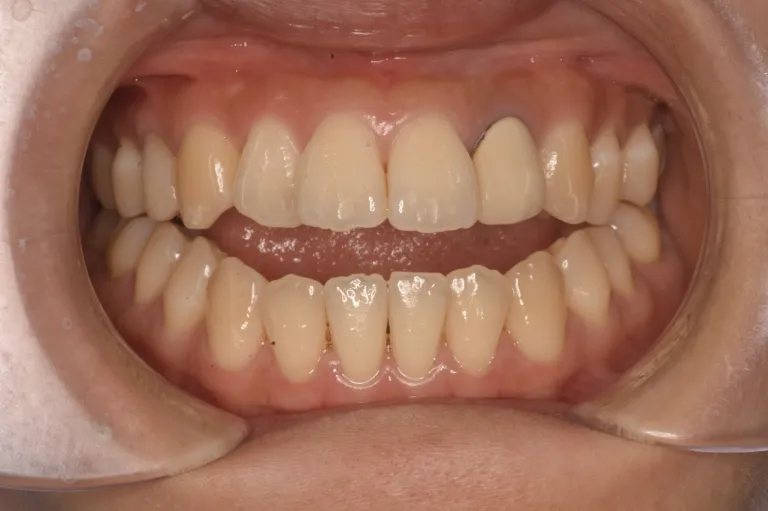 開咬（オープンバイト）とは