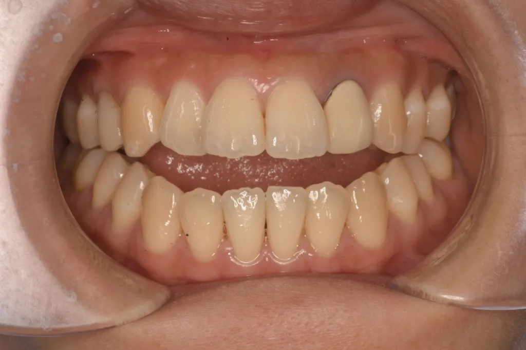 治療前 開咬（オープンバイト）と呼ばれる状態