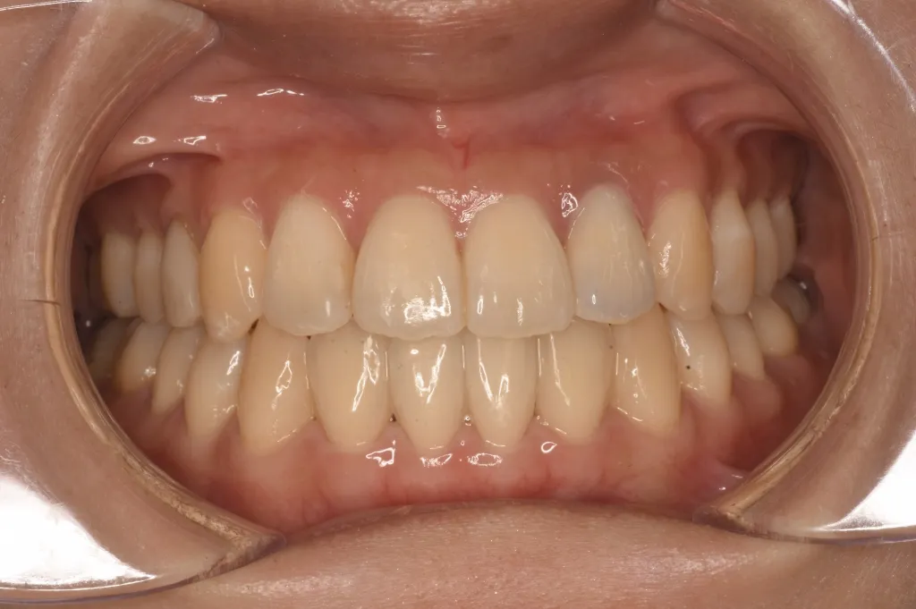治療後 手術を回避してマウスピース矯正で治療