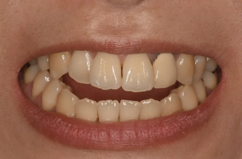 笑った時の状態 常に前歯が開いている