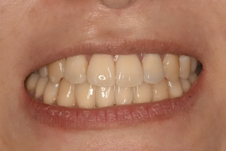 治療後 前歯が閉じて、しっかり噛めるようになりました