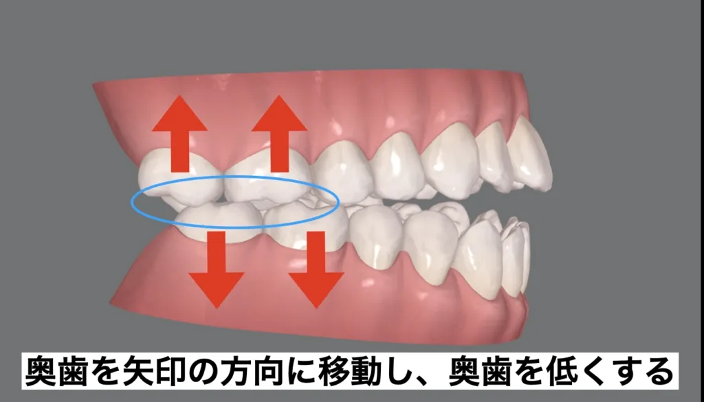マウスピース矯正で開咬は治療できる？
