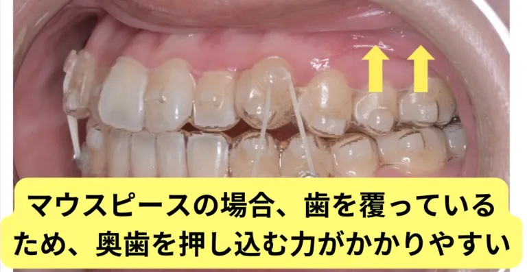 ①奥歯の圧下（沈み込ませる動き）が得意
