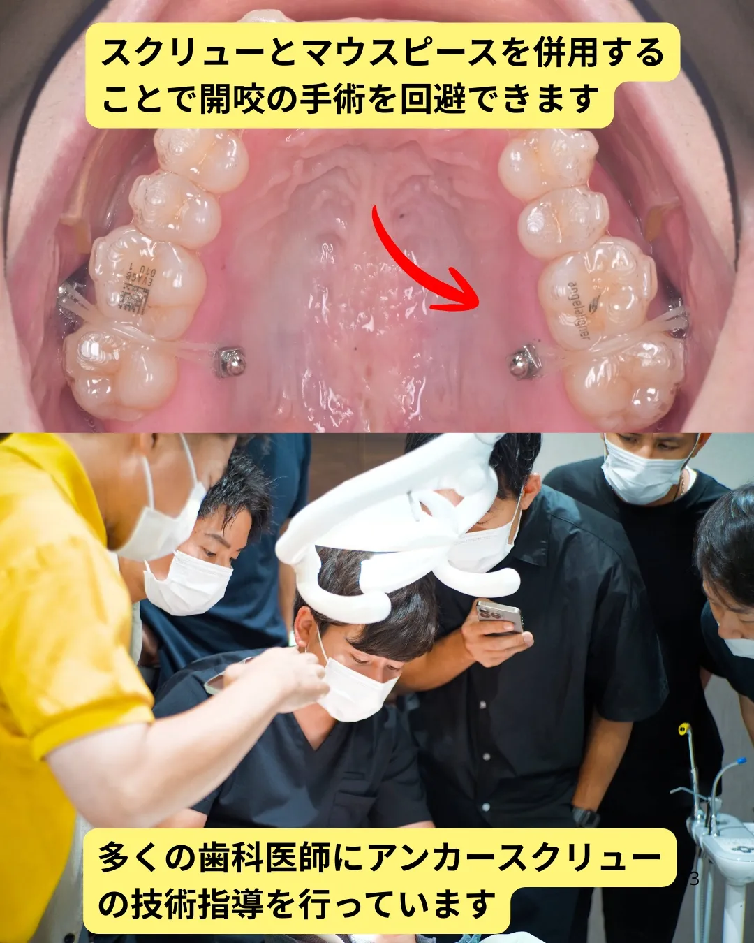 ②顎間ゴムやインプラントアンカーとの併用で治療の幅が広がる