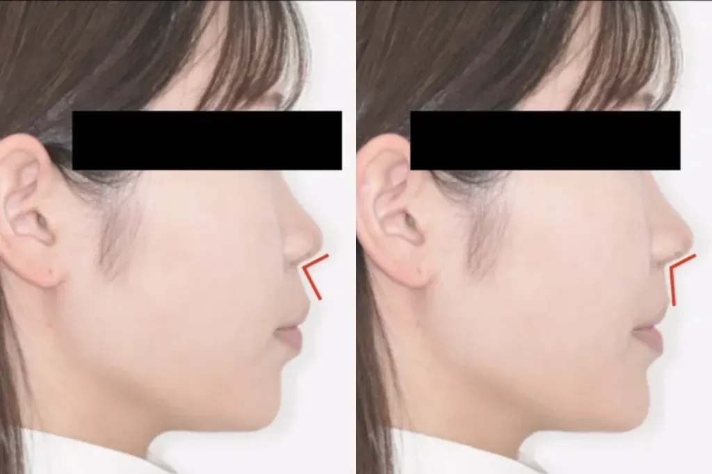 ④矯正後の顔貌変化もシミュレーションで確認できる