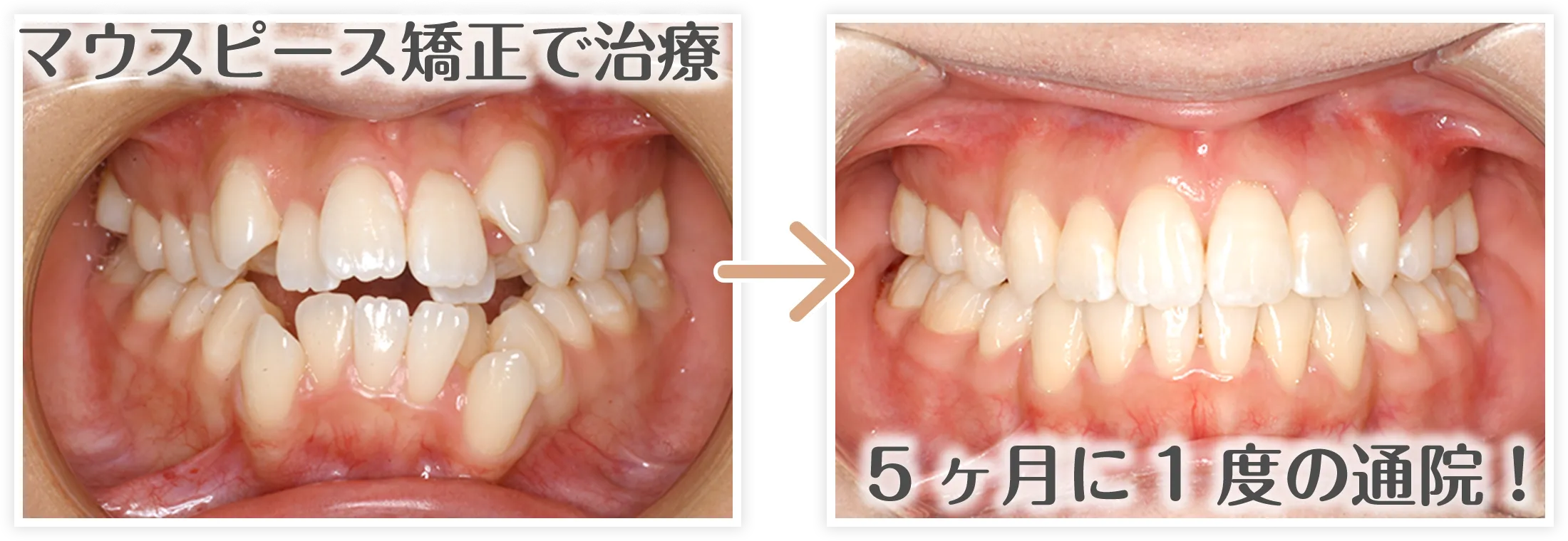マウスピースbefore