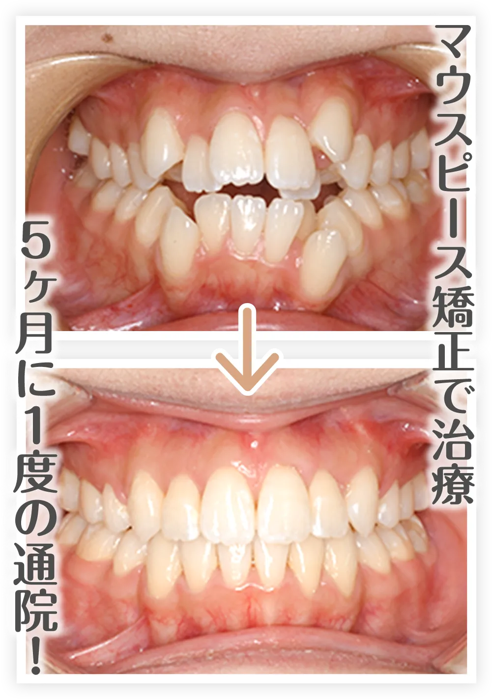マウスピースbefore