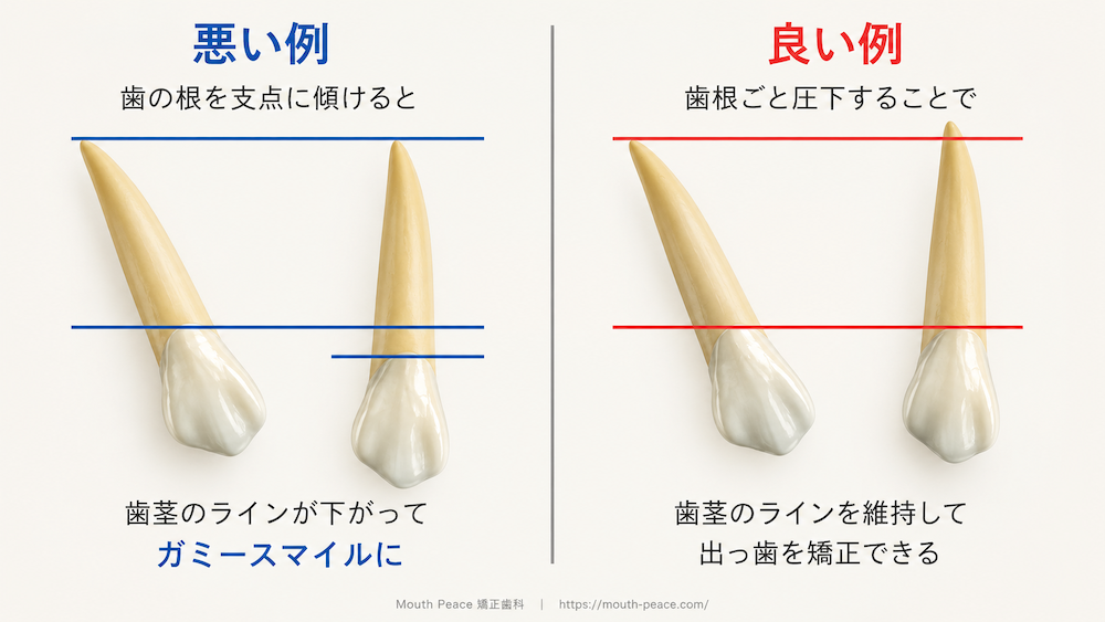 歯の根の動きによって、出っ歯の矯正治療後に歯茎がどの程度見えるのか(つまりガミースマイルになるのかどうか)を示した図