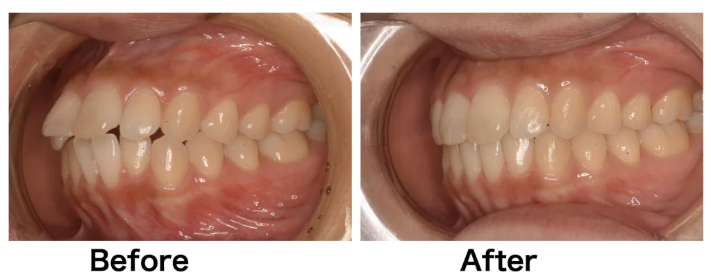 マウスピース矯正で出っ歯は治せる？出っ歯になってしまうケースも？原因と対策を分かりやすく解説
