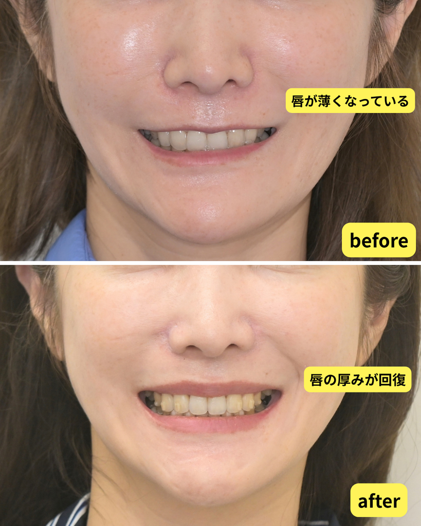 歯を前に出す矯正 唇の変化