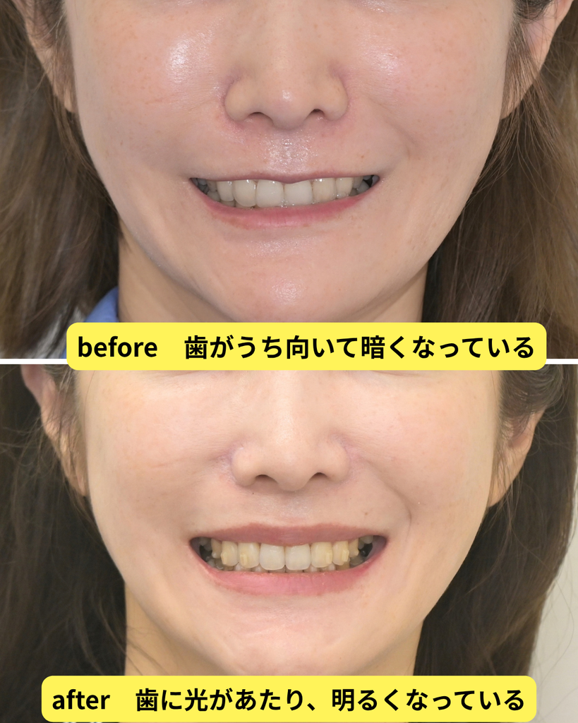 引っ込みすぎた口元を改善する再矯正治療