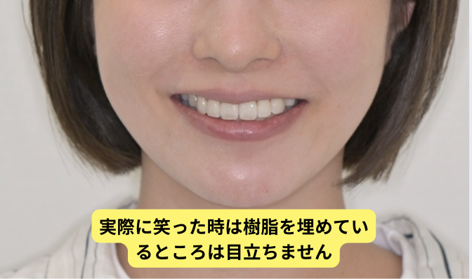 歯を前に出す矯正治療後の写真
