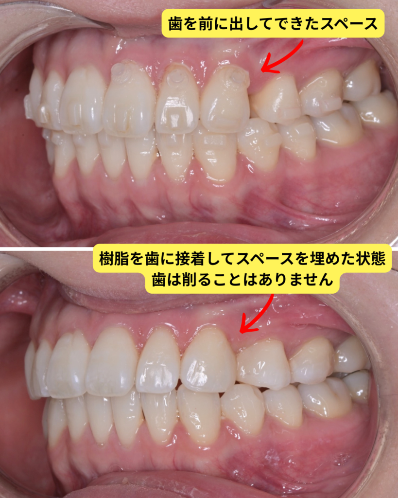 歯を前に出してできたスペースを樹脂で埋めている写真