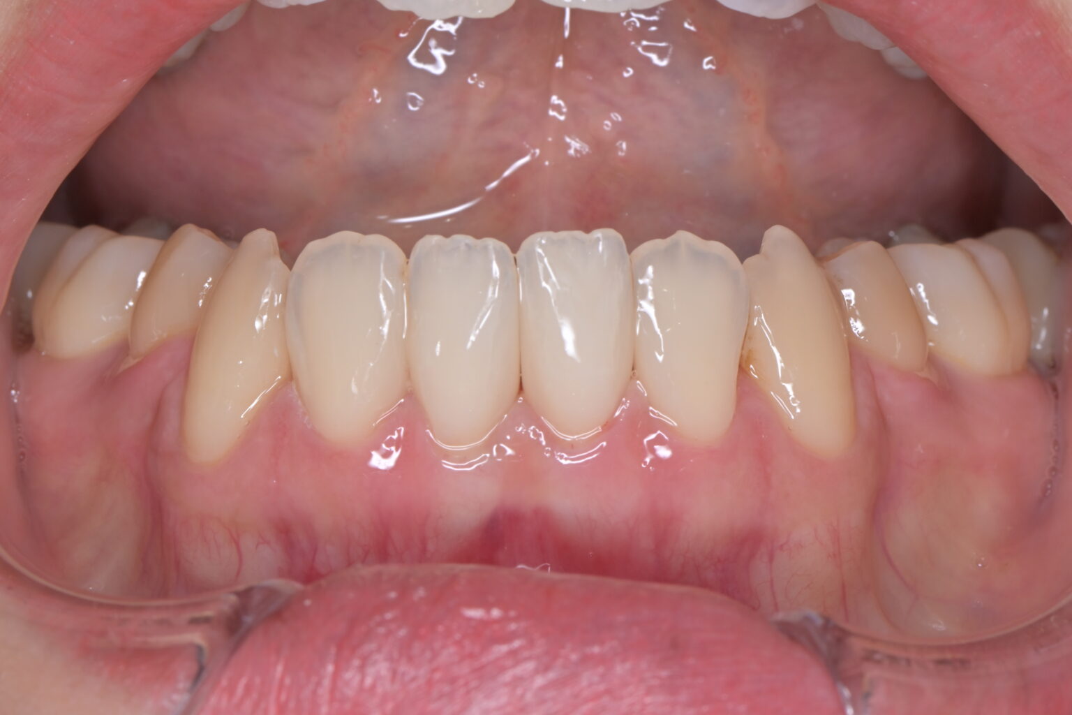 治療後になります。