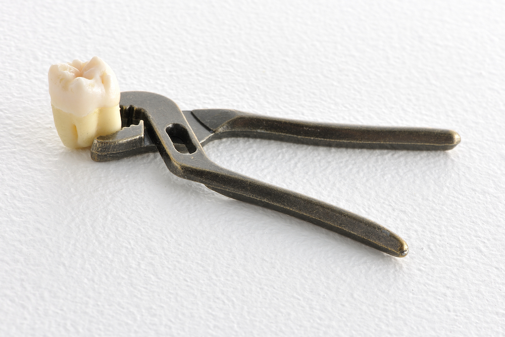 矯正治療の際に抜歯が必要な理由