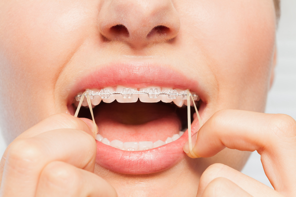歯列矯正のゴムかけの効果や有効な症例、痛みの有無や治療期間について