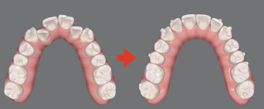 非抜歯矯正で歯を並べるスペースを作る方法