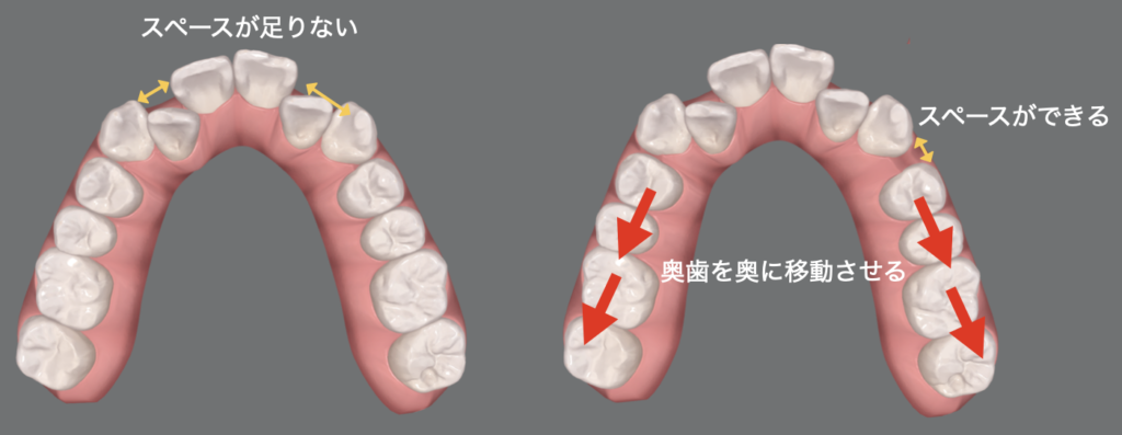 非抜歯での遠心移動の補助