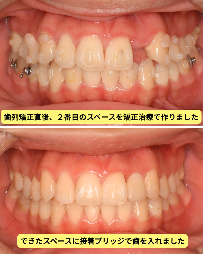 矯正で作ったすき間に接着ブリッジで歯を入れた前後の正面