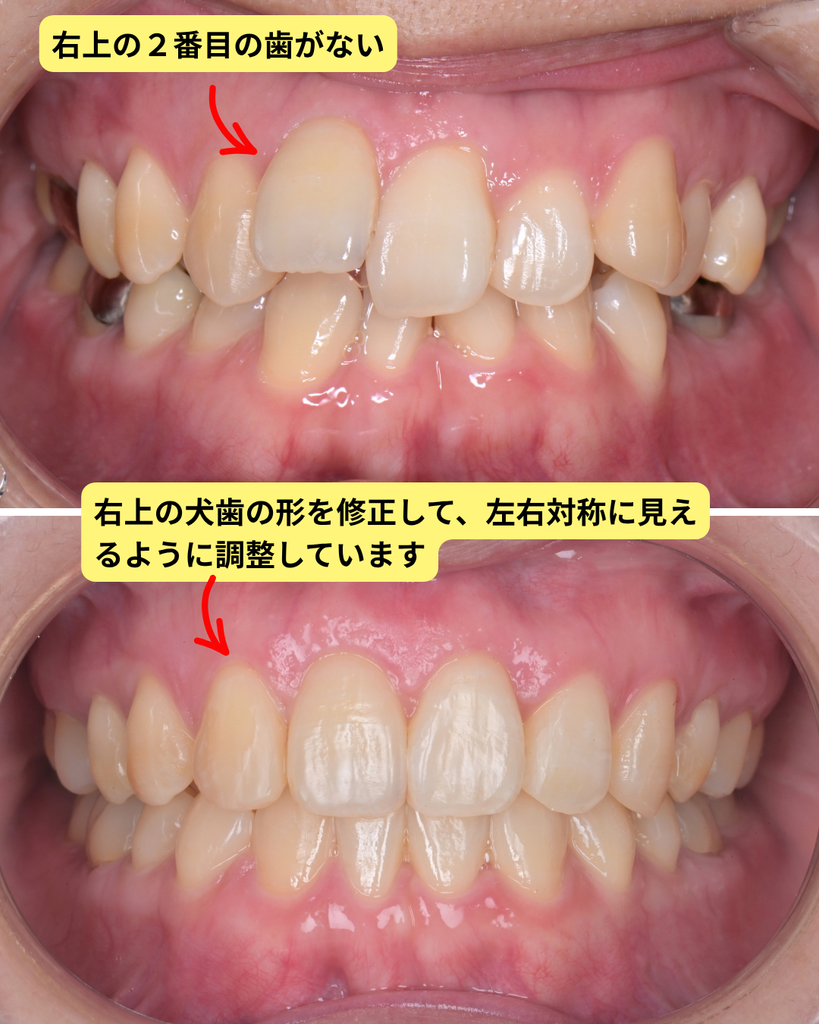 歯が1本足りない 矯正