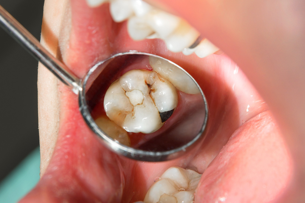 インビザライン矯正中に虫歯になる？虫歯の予防法となった際の対処法を解説