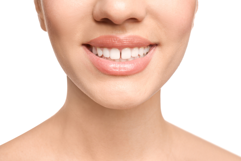 前歯のすきっ歯を矯正治療で治せる？治療方法や期間などすきっ歯の全てを解説