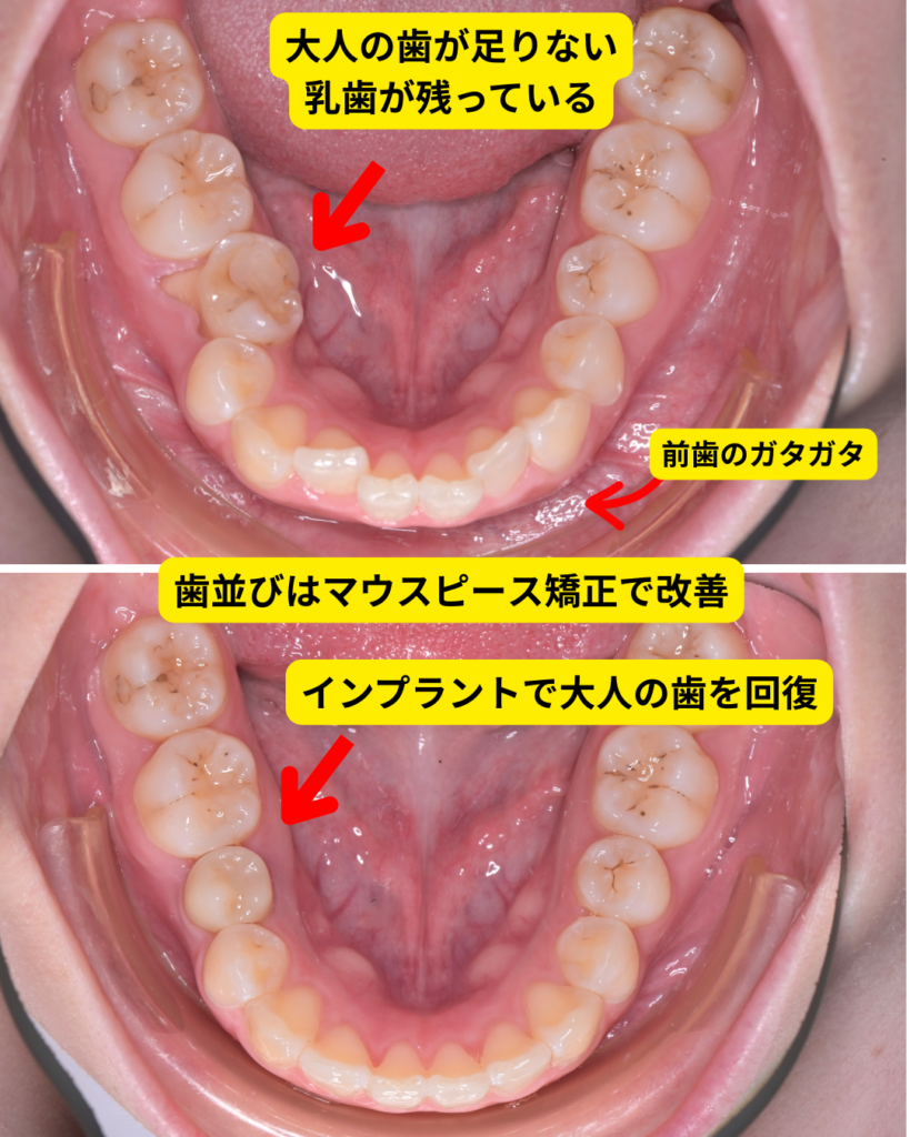大人で乳歯が残っている症例。前歯のガタガタはマウスピース矯正で改善し、乳歯を抜歯後にインプラントで大人の歯を回復した治療例