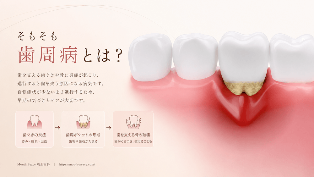 そもそも歯周病とは?