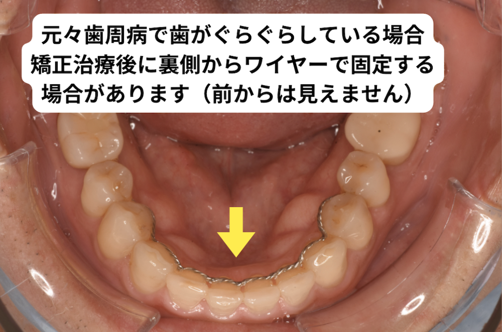 歯がグラグラしている場合は矯正治療後に固定を行います