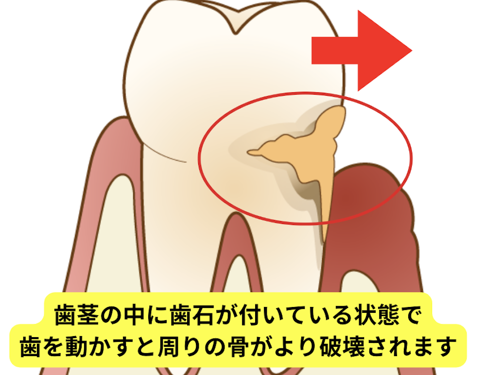 ①歯周病が進行・悪化する