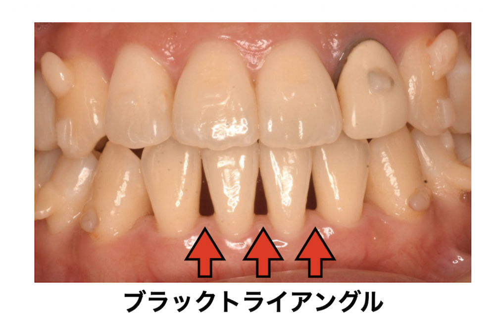 ③ブラックトライアングルができる