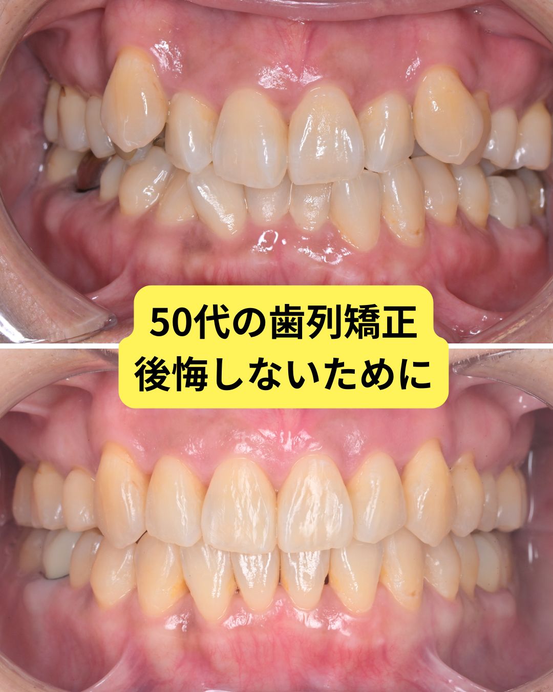 50代の歯列矯正　後悔