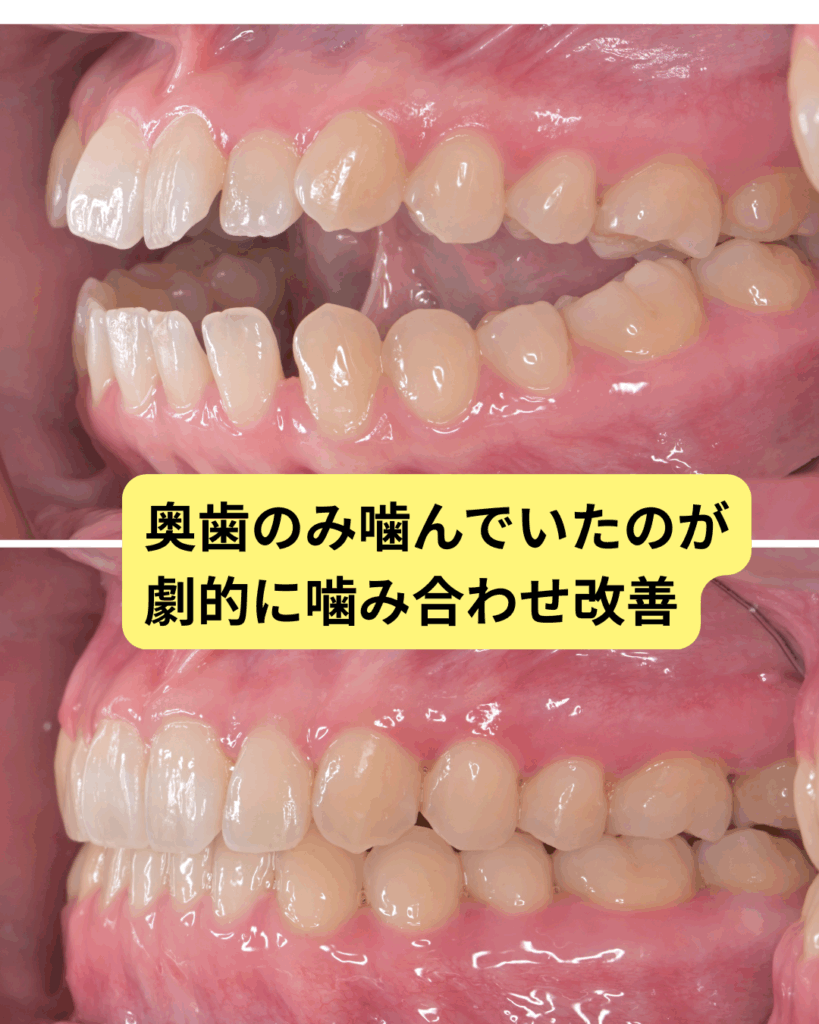 手術と診断された開咬を改善|オープンバイトのマウスピース矯正症例 | マウスピース矯正歯科