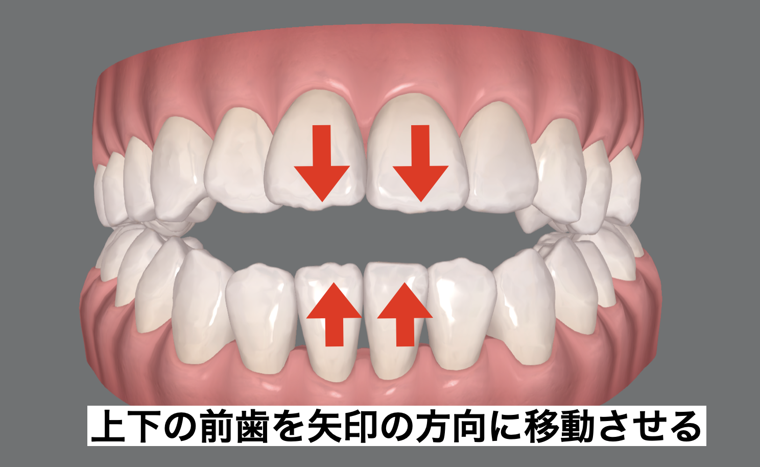 開咬は手術が必要?オープンバイトをマウスピース矯正で改善できるケース | ワイヤー矯正をしたくない方向けの大阪の専門医院 | マウスピース矯正歯科